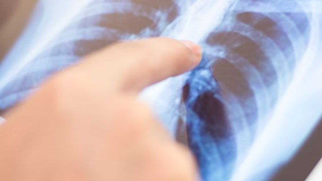 Mengenal Efusi Pleura: Penyebab, Gejala, dan Cara Mengobatinya