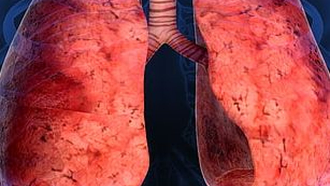 Dampak Polusi Udara terhadap Paru-Paru, Bisa Sebabkan Kanker Paru