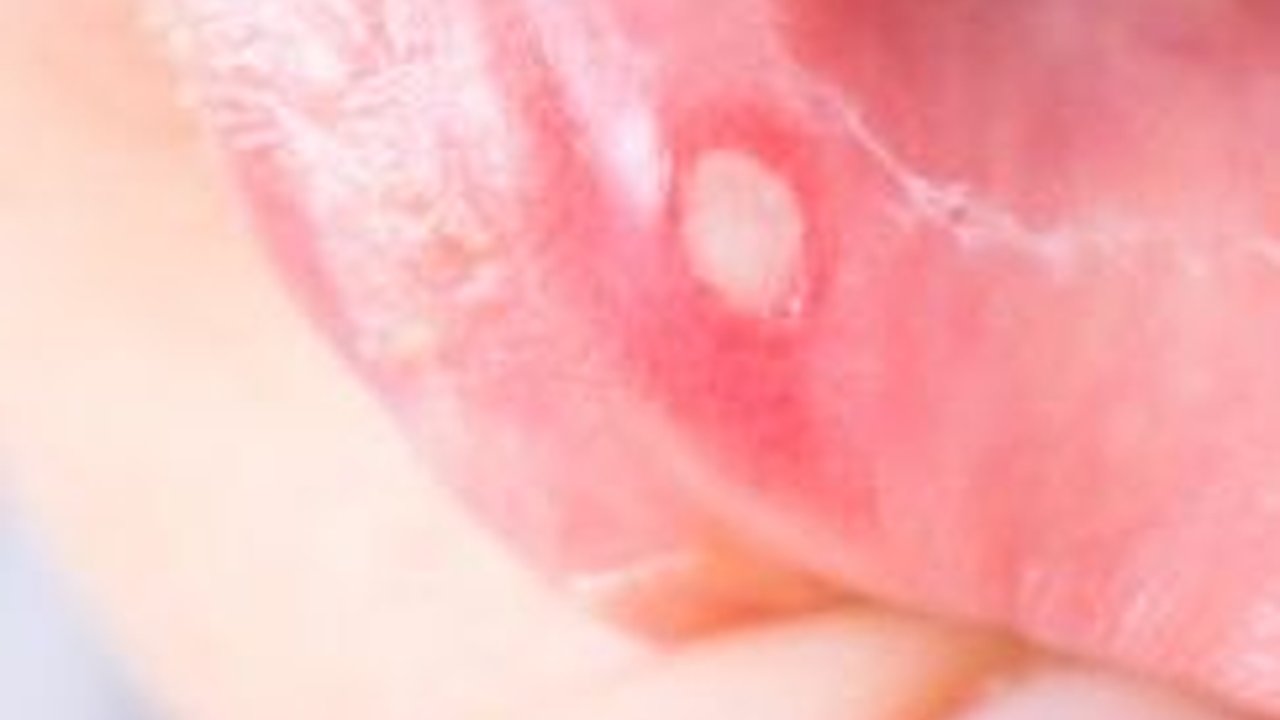 8 Obat Sariawan Anak yang Efektif, Orang Tua Wajib Tahu