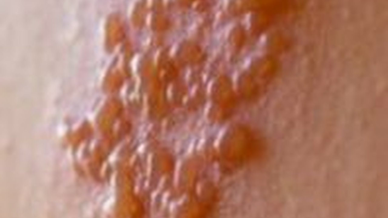 Waspadai Penyebab Penyakit Herpes Kulit, Bisa Menular Melalui Kontak Kulit