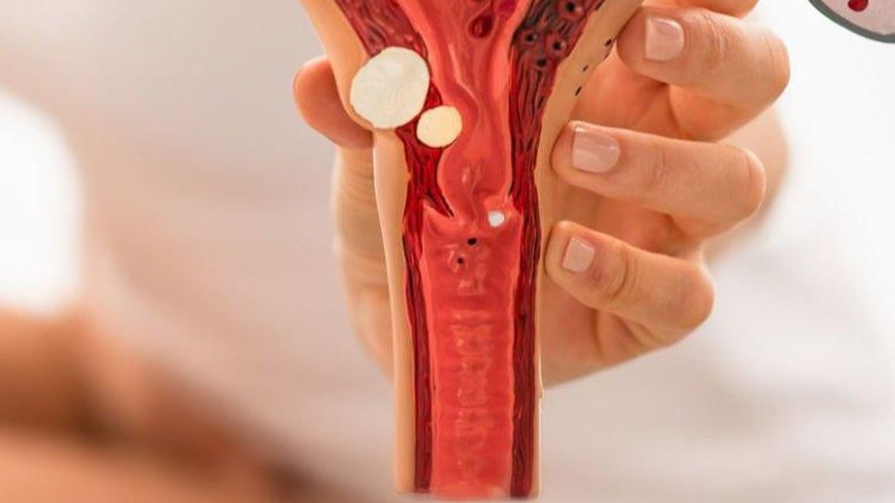 Tanda-tanda Kista yang Perlu Diwaspadai, Ketahui Penyebab dan Cara Mengatasinya