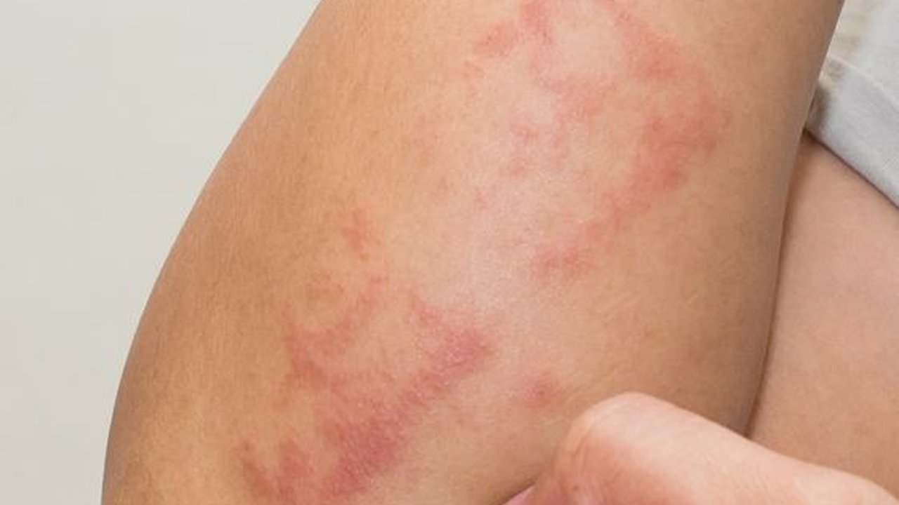 Apa Itu Penyakit Dermatitis? Ketahui Gejala, Penyebab dan Cara Mengobatinya