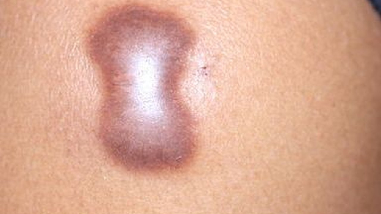 10 Cara Mudah dan Praktis Mencegah Luka Berubah Menjadi Keloid