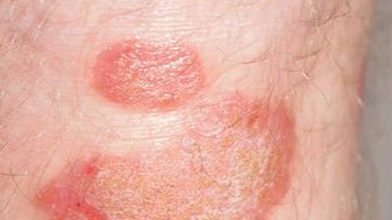 Mengenal Psoriasis Vulgaris: Pemicu, Penyebab, Gejala, dan Dampak Negatifnya