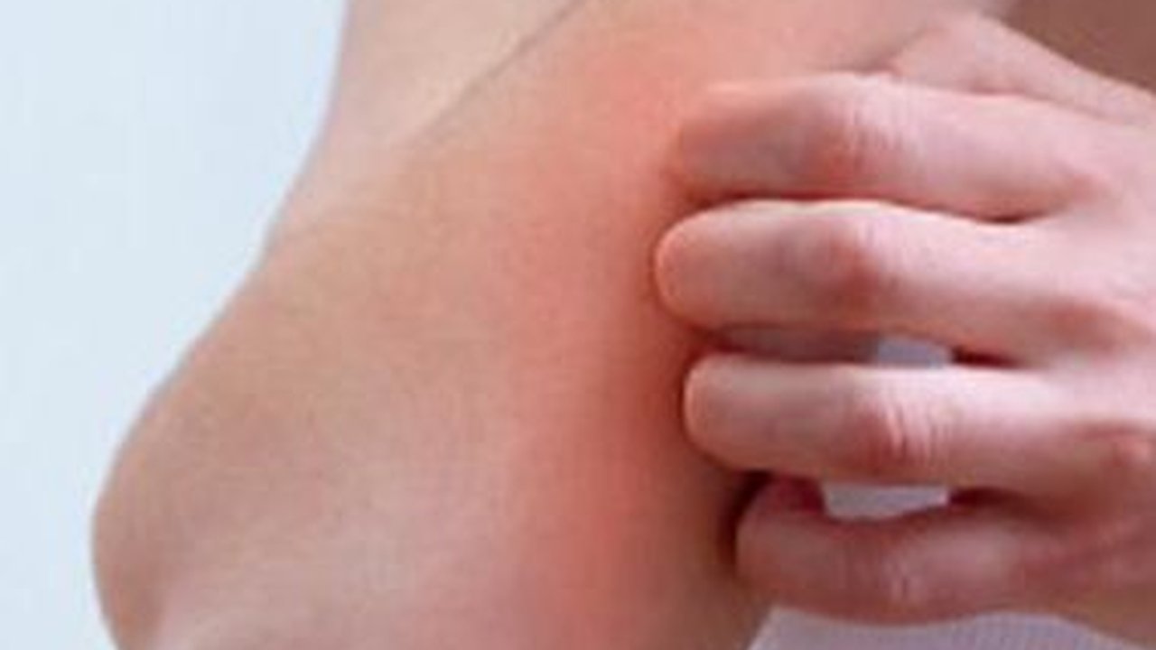 Gejala Psoriasis Vulgaris, Gangguan Autoimun Lesi Merah dan Bercak pada Kulit