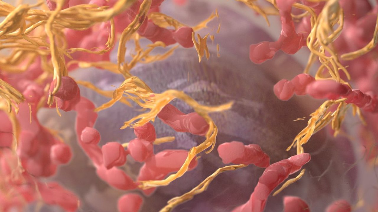 Tanda-Tanda Metastasis, Penyebaran Sel Kanker ke Jaringan Tubuh yang Perlu Diwaspadai