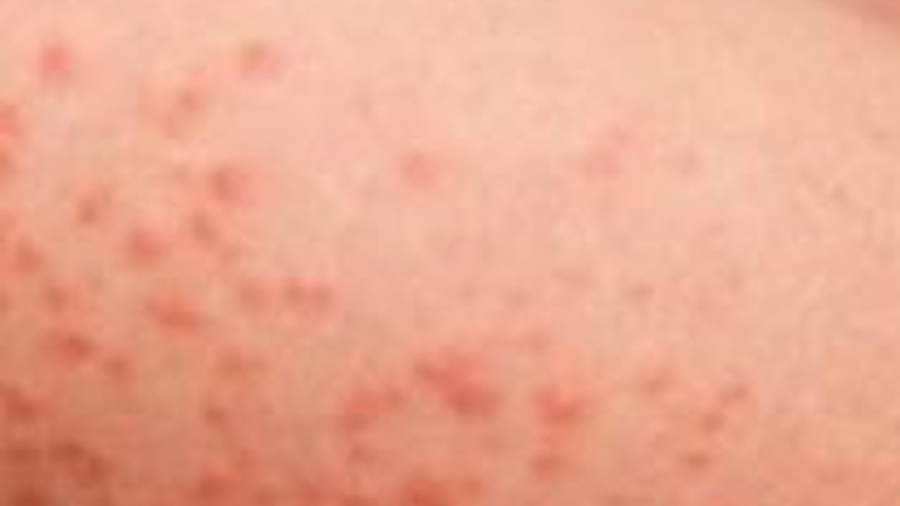 Perhatikan Lagi Ini Bedanya Cacar Air, Campak, dan Rubella