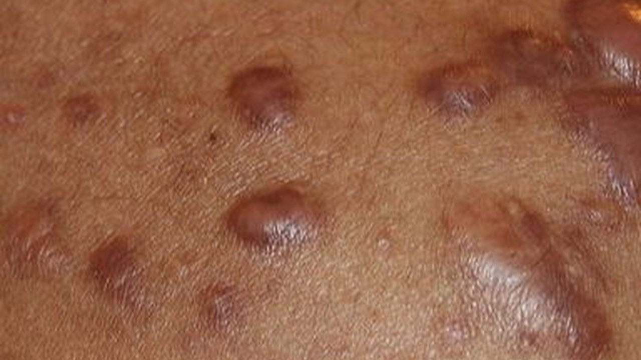 9 Cara Mudah dan Sederhana Obati Keloid di Rumah secara Mandiri