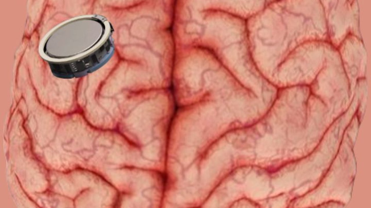 Perusahaan Punya Elon Musk Ini Lagi Cari Relawan Tanam Chip di Otak, Begini Syaratnya