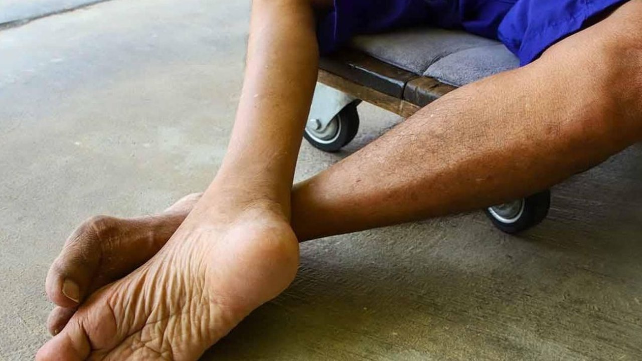 WHO Beri Peringatan Darurat! Polio yang Bisa Menyebabkan Lumpuh Layu Akut Kembali Menghantui Indonesia