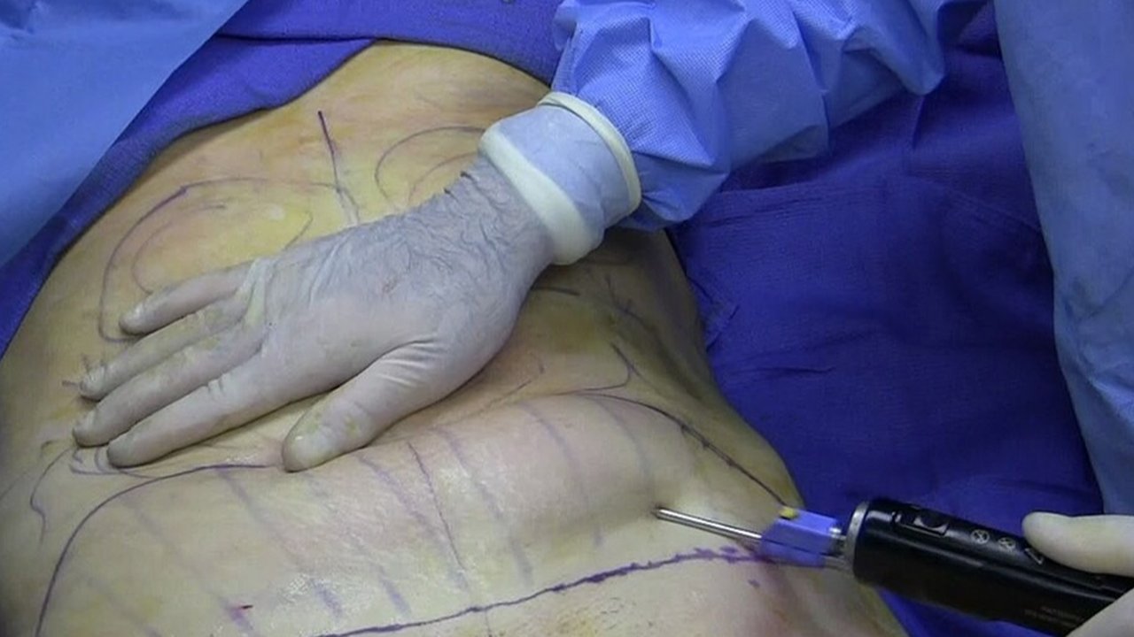 Ilustrasi Sedot Lemak