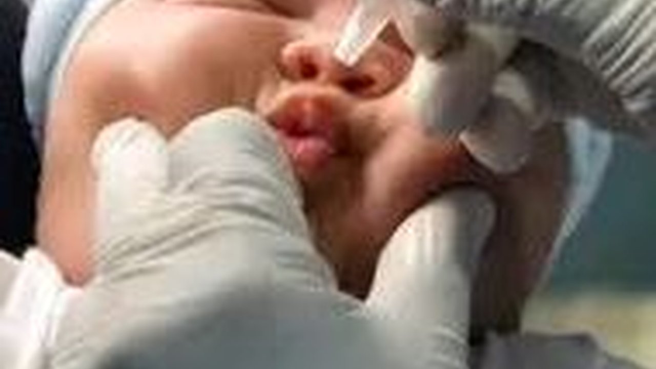 Dokter Ungkap Penyebab Anak Rentan Kena Polio