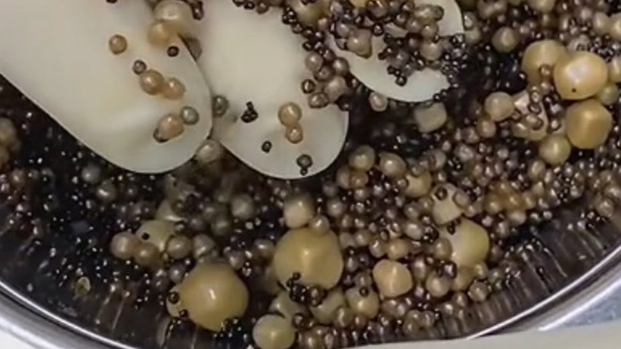 Bukan Manik-manik Aksesoris, Begini Penampakan Batu Empedu dari Organ Hati Pasien