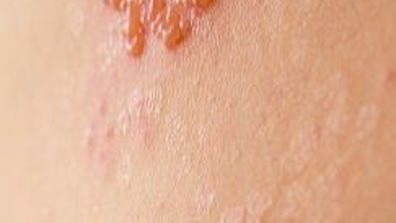 Mitos Dompo Alias Herpes Zoster yang Harus Diketahui, Simak Penyebabnya