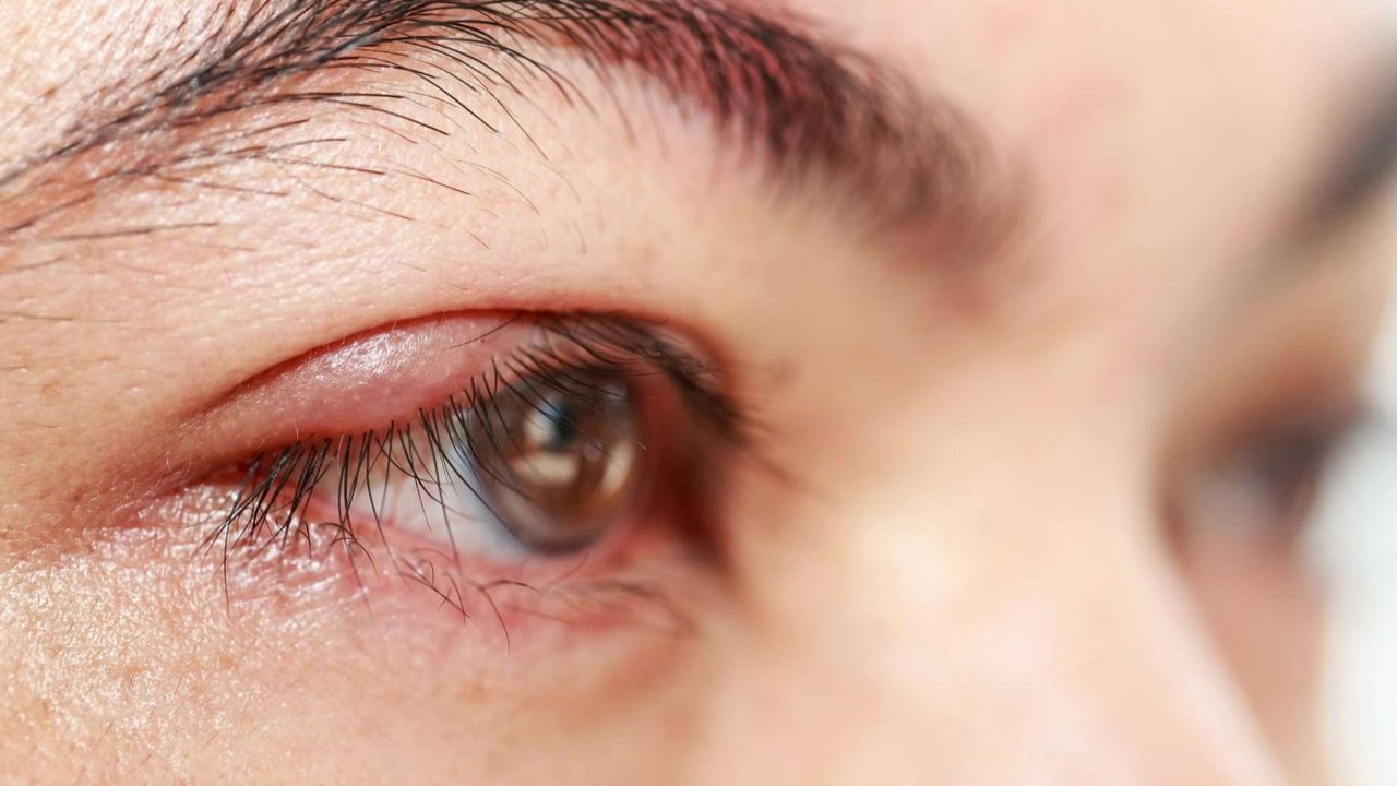 doa sakit mata bintitan