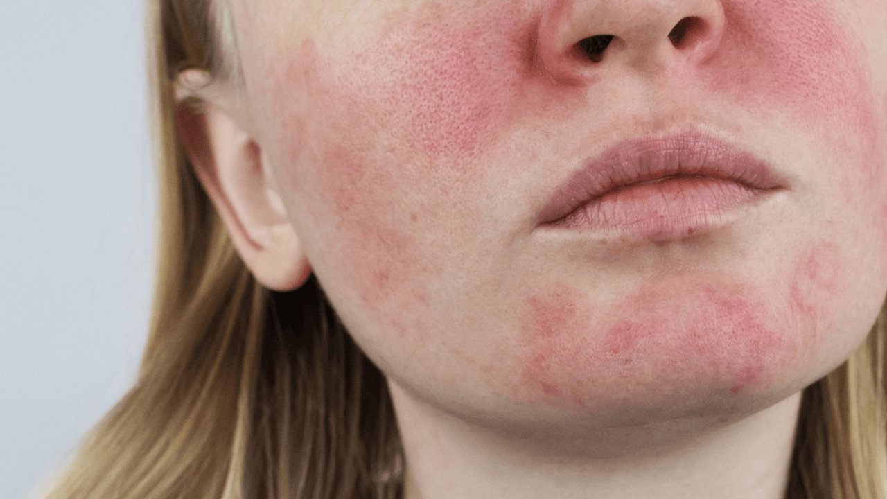 Cara Mengatasi Biang Keringat pada Anak secara Alami