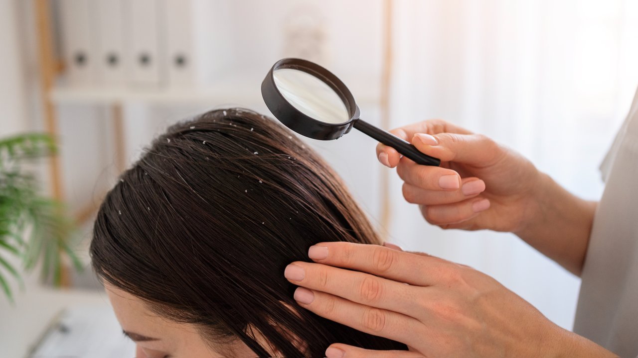 Perawatan Alami untuk Rambut Berketombe: Apa yang Harus Dilakukan?