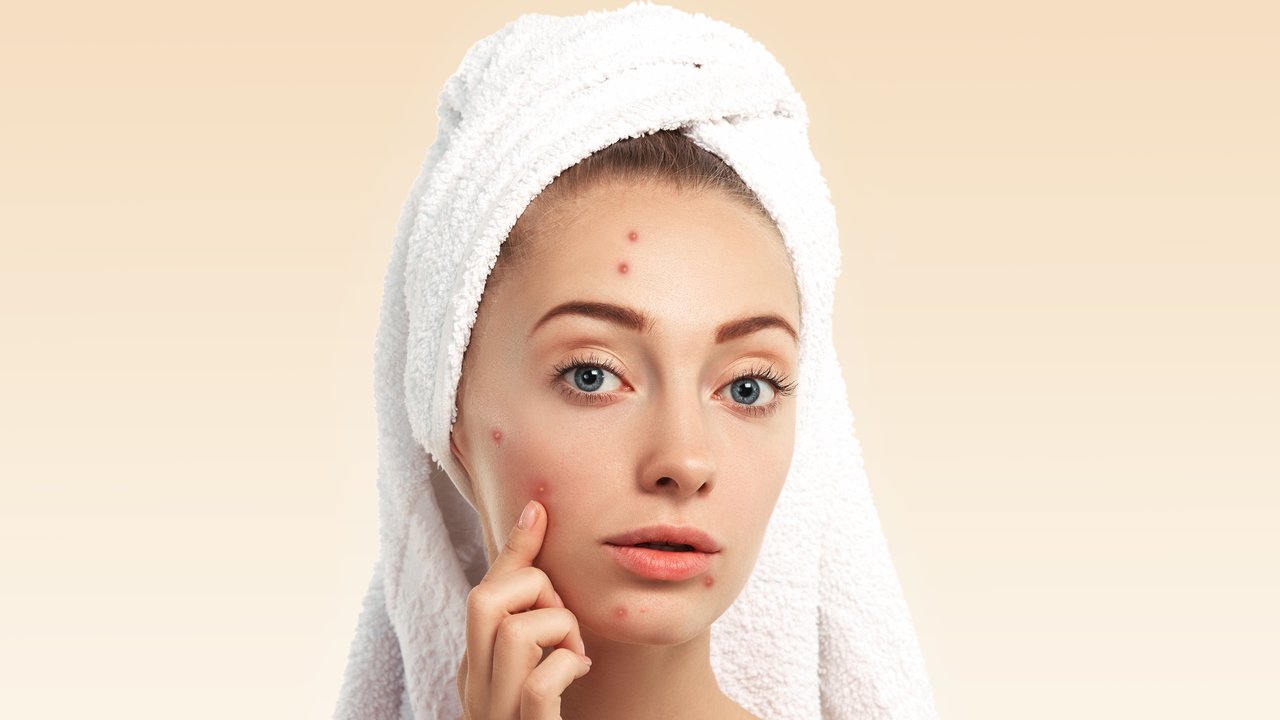 Jerawat Hilang Tanpa Skincare? Ini 9 Cara Alami yang Bisa Dicoba