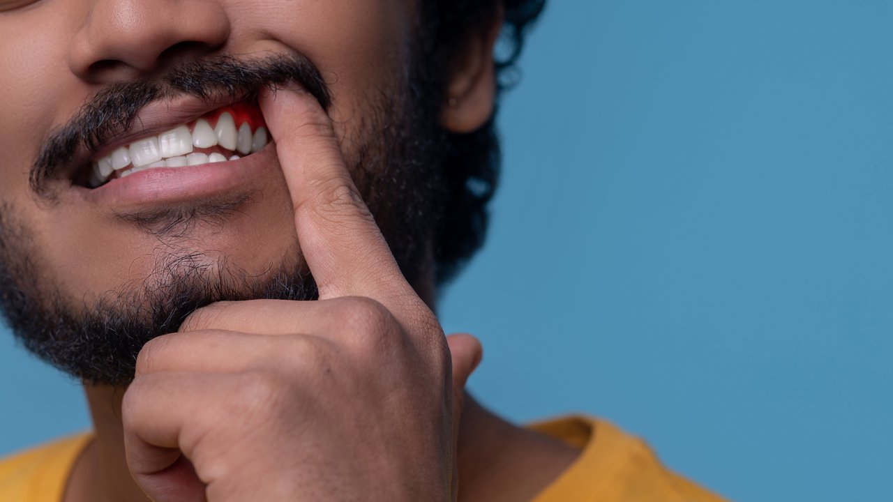 Pengobatan Alami untuk Gusi Bengkak