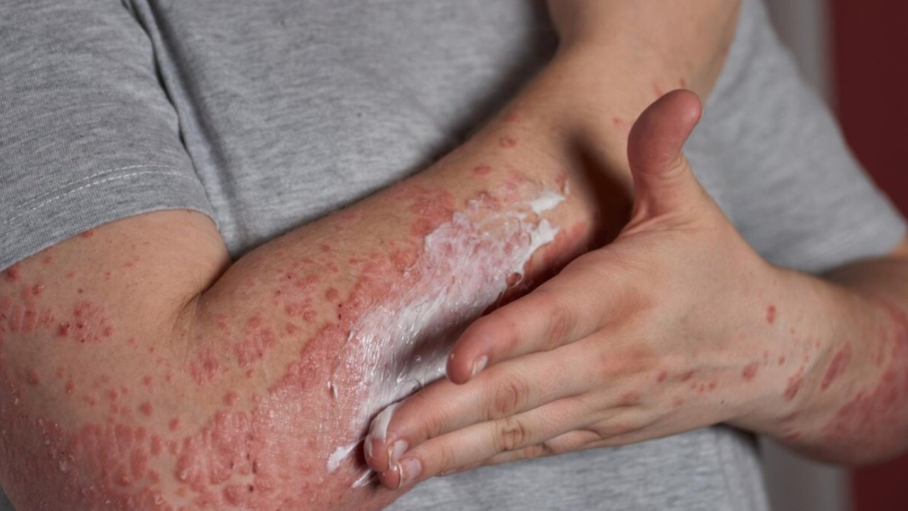 Steven Johnson Syndrome: Panduan untuk Pasien dan Keluarga dalam Proses Diagnosa
