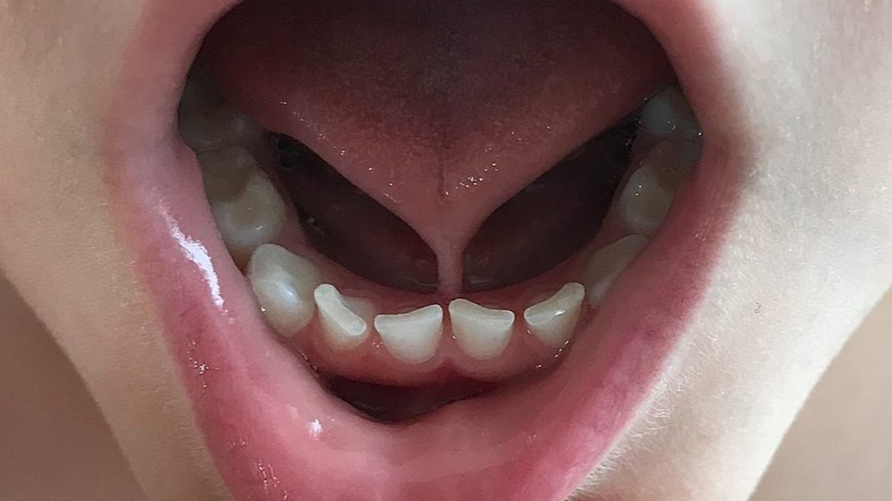 Ilustrasi Tongue Tie