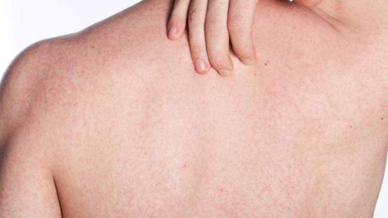 Bahan Alami untuk Mengatasi Panu dengan Cepat dan Efektif Credit: pexels.com/Sunsetod