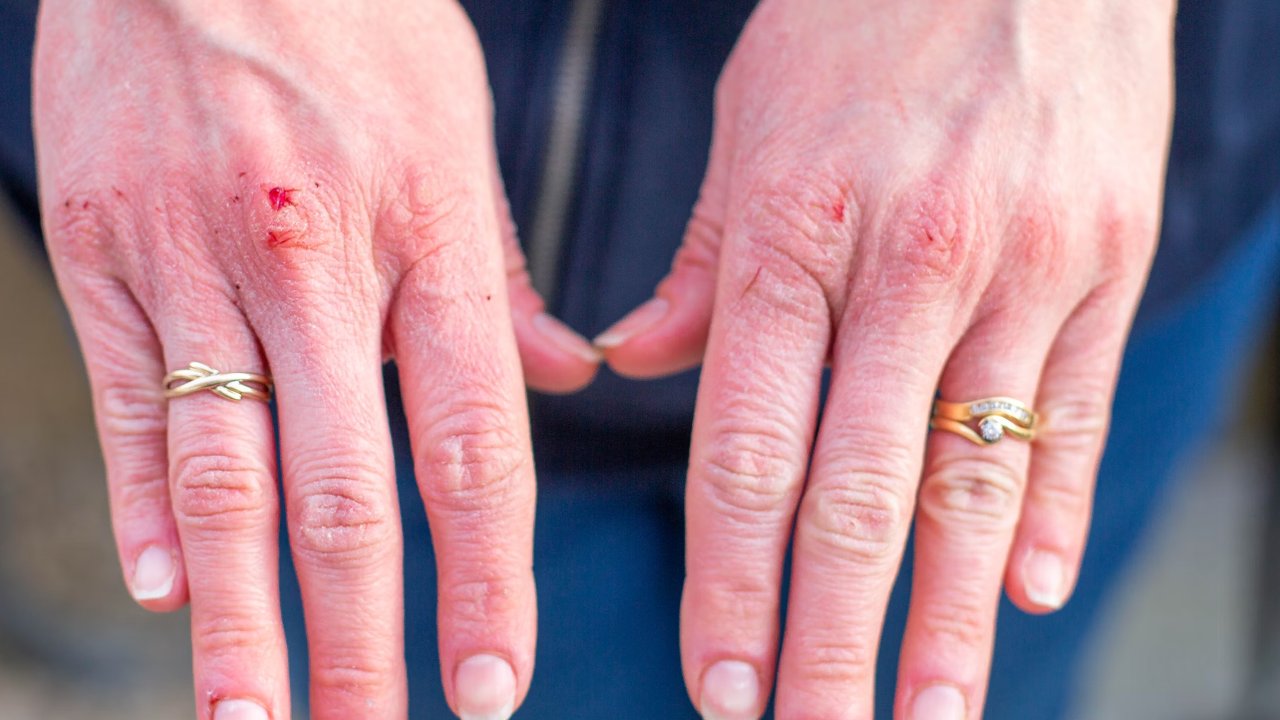 Mengapa Luka Akibat Benda ini Terasa Lebih Sakit