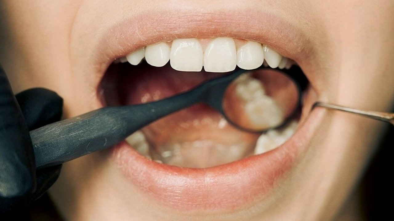 Peran Gula dalam Karies Gigi