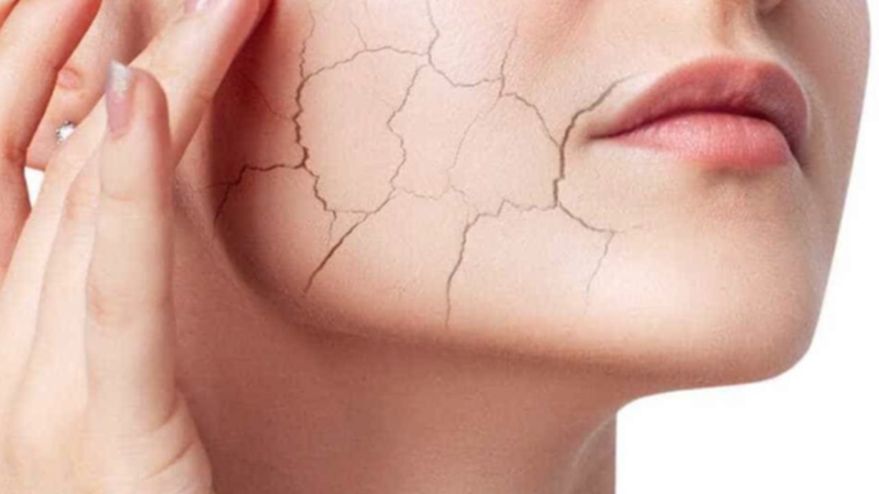 Jangan Biarkan Kulit Kering Mengganggu! 6 Tips Ampuh Atasi Kulit Kering Saat Musim Dingin