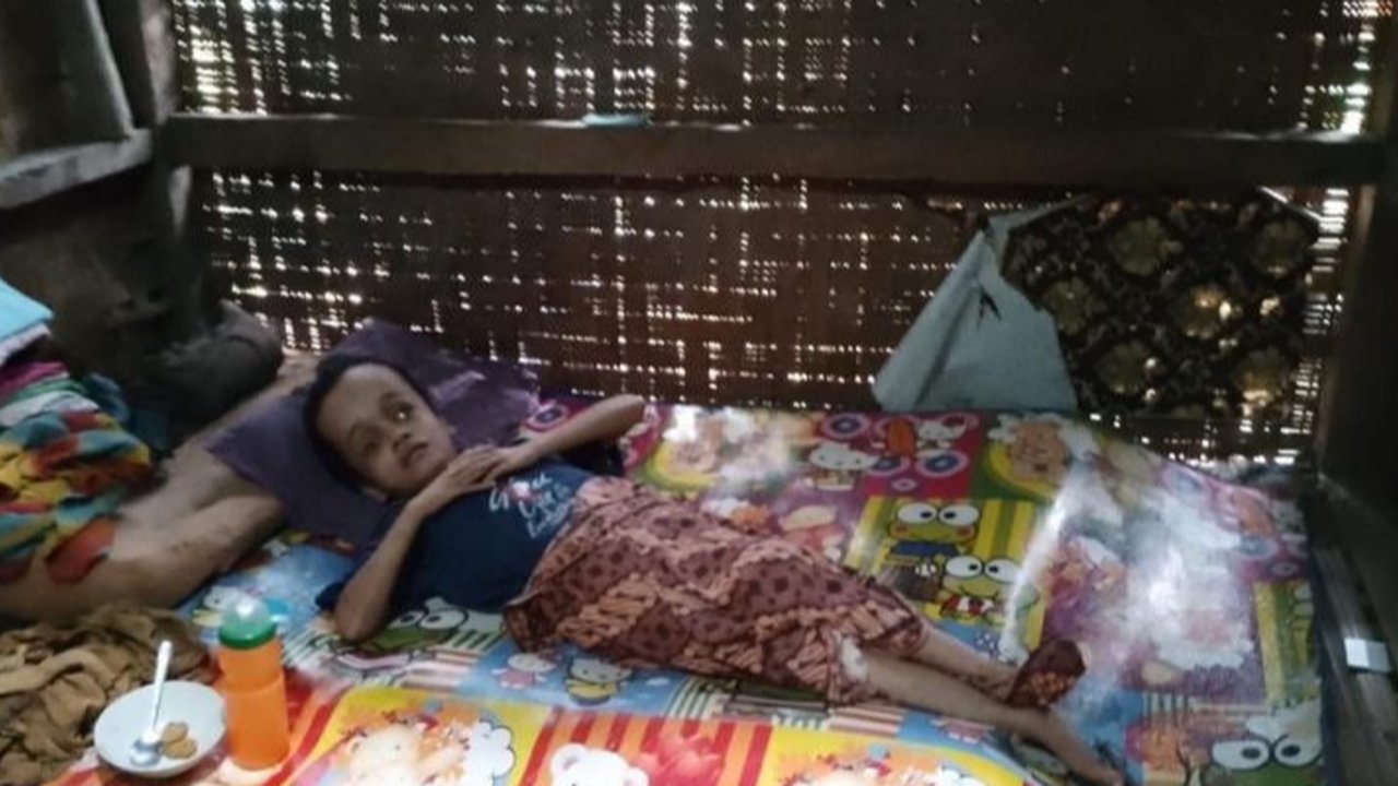 gadis penderita hidrosefalus