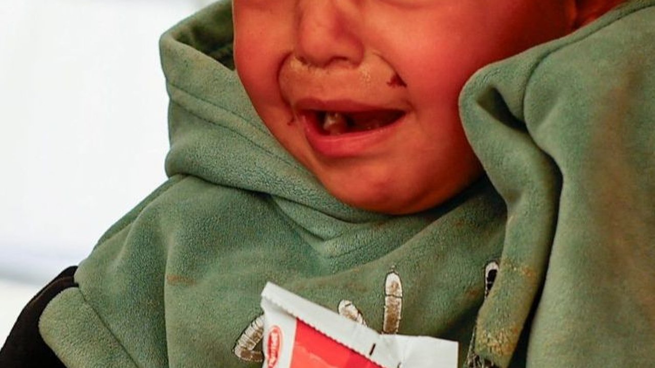 FOTO: Potret Anak-Anak Palestina Menderita Kekurangan Gizi di Pengungsian Rafah, Gaza Selatan