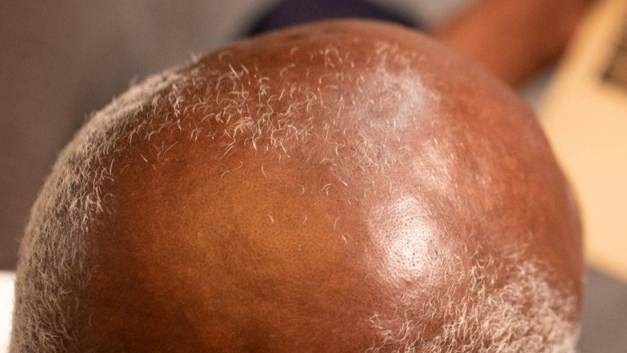 10 Bahan Alami untuk Menumbuhkan Rambut Botak, Bisa Dicoba