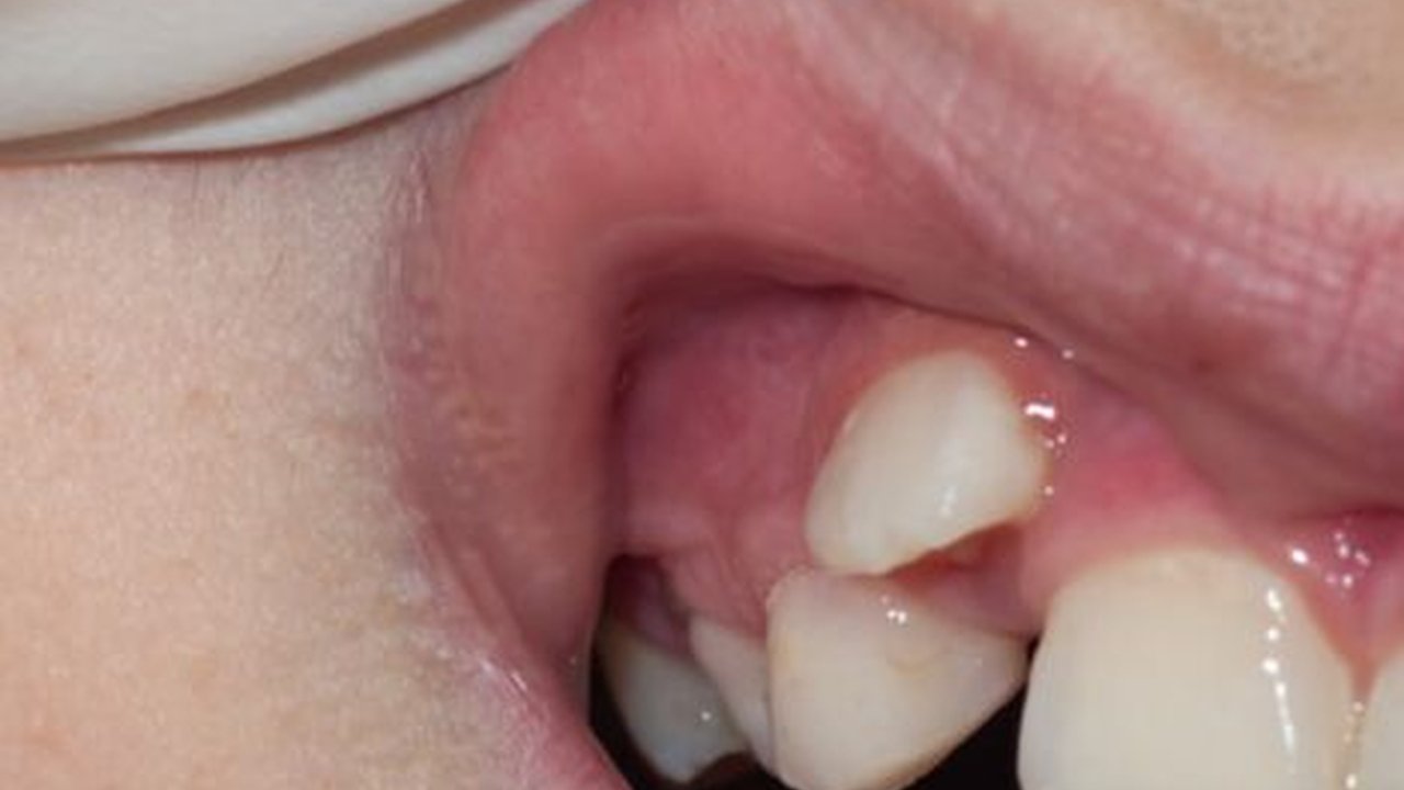 Dampak Buruk Gigi Gingsul yang Perlu Diwaspadai, Tak Selalu Menarik