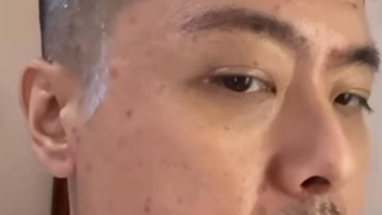 Potret Pilot Vincent Raditya Idap Flu Singapura, Keluar Bintik di Wajah dan Kepala Hingga Bernanah