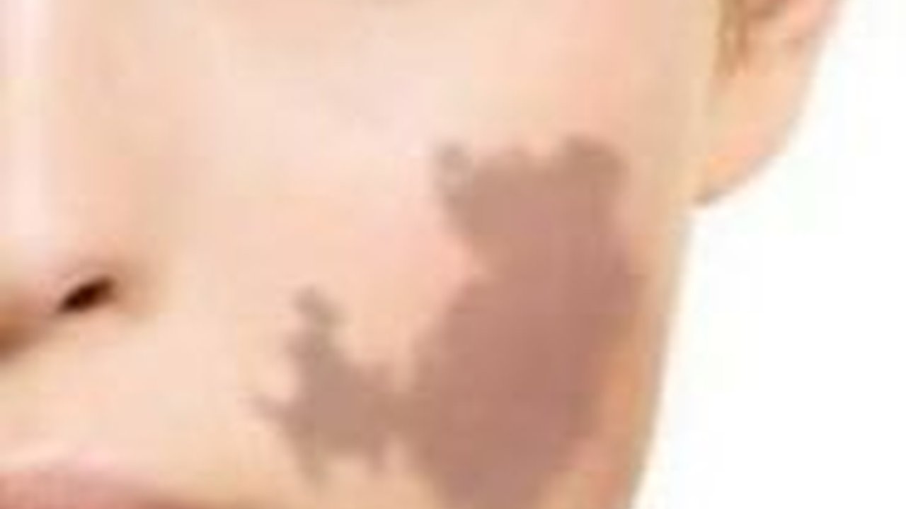 4 Cara Menghilangkan Tanda Lahir Secara Alami, Lengkap dengan Jenis-Jenisnya yang Perlu Diketahui