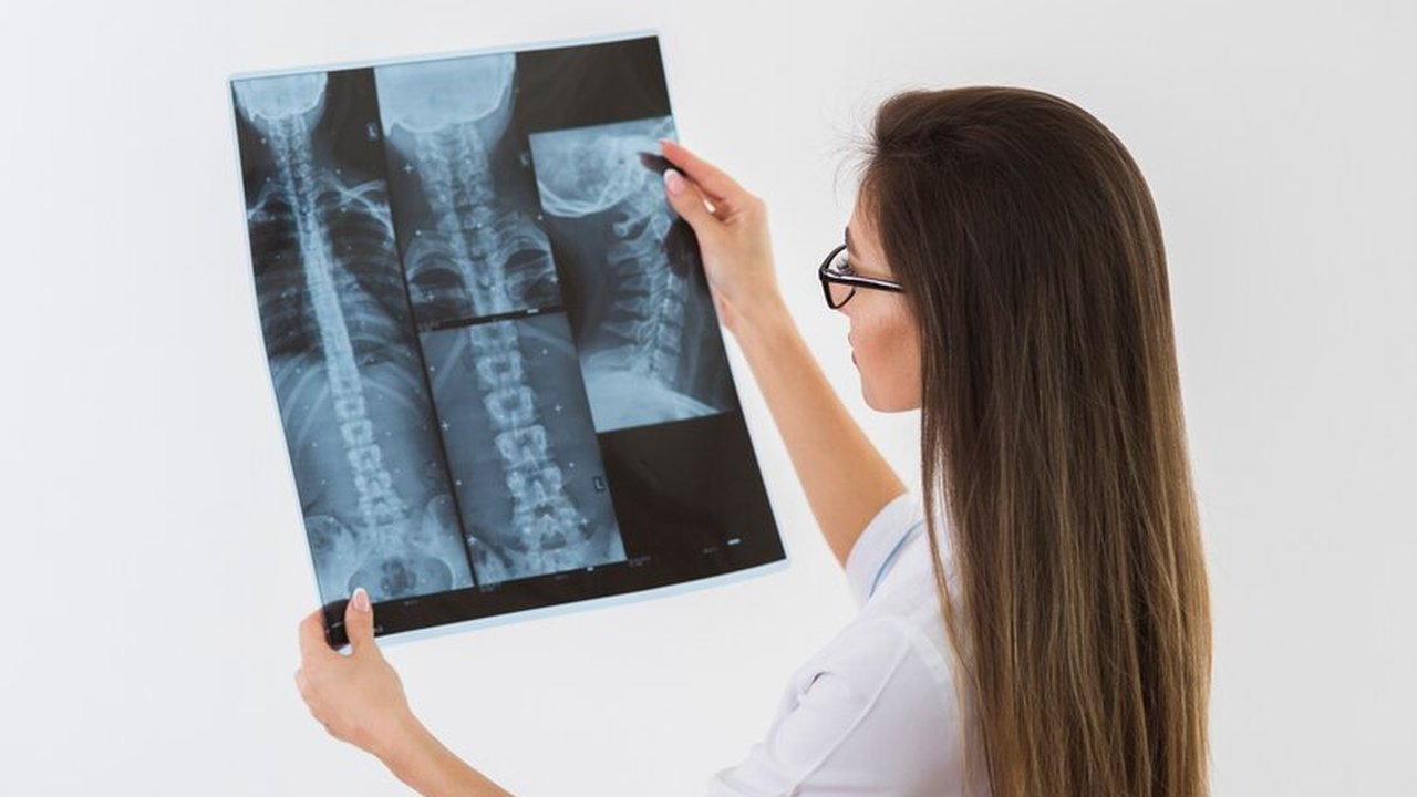 Ilustrasi Osteoporosis