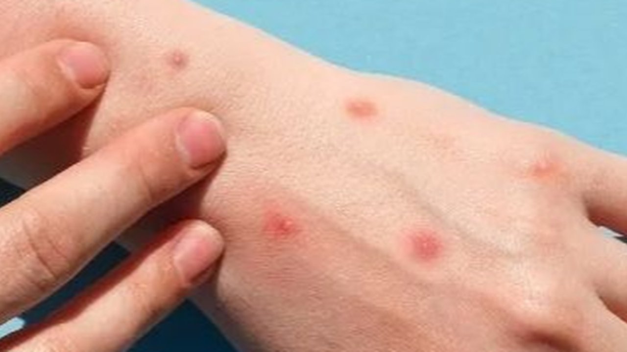 Cacar Monyet pada Anak