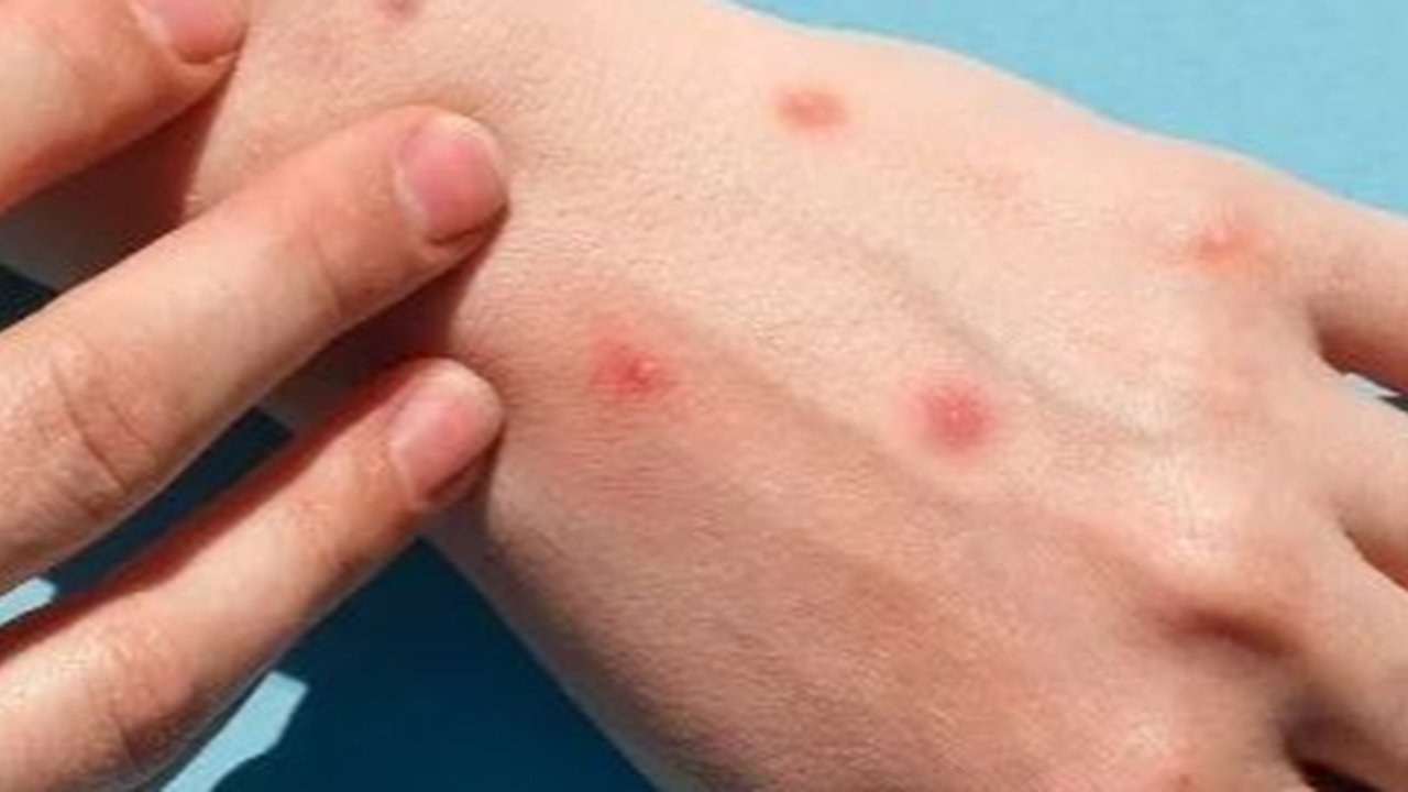 Cacar Monyet pada Anak