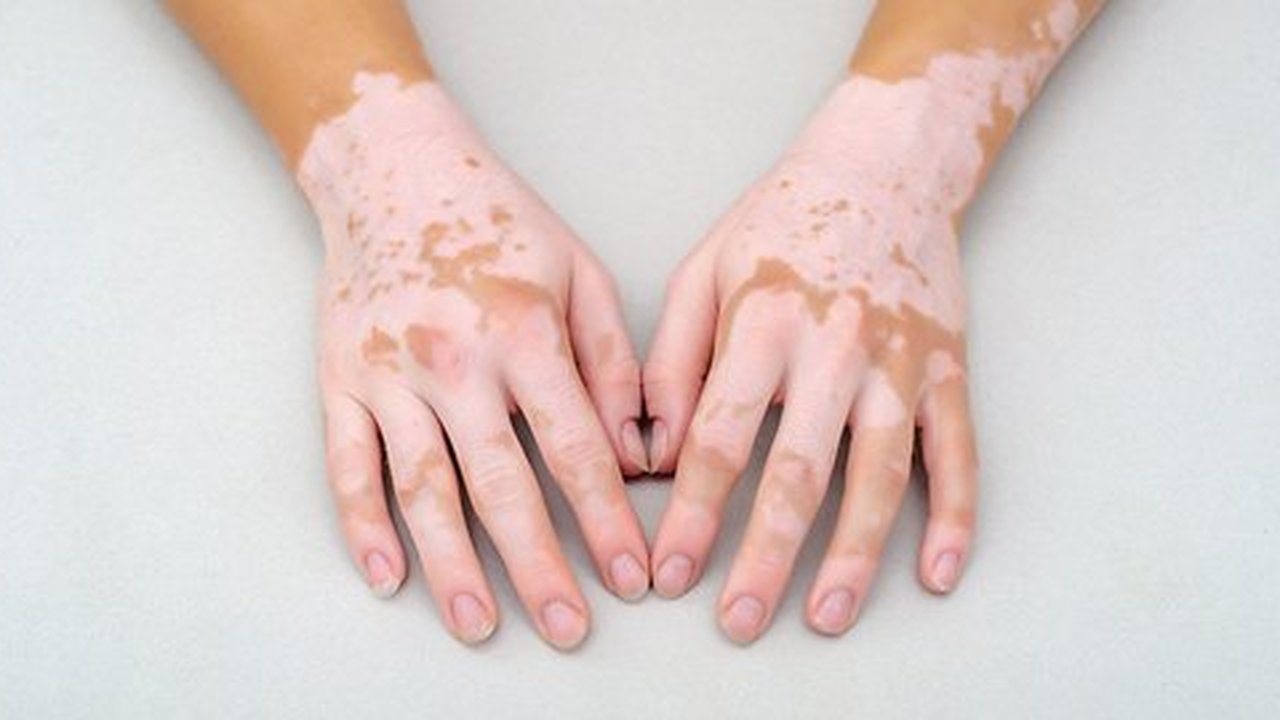 vetiligo