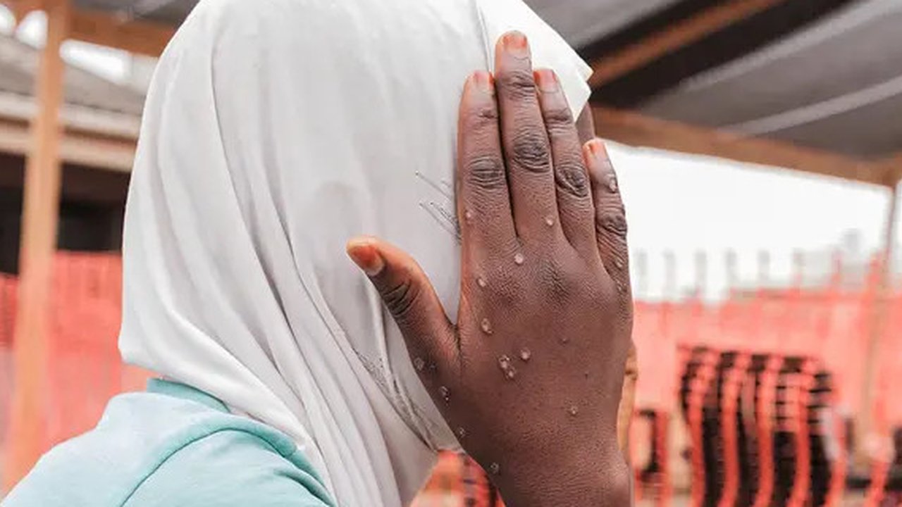 Clade 1b menyebabkan kematian pada sekitar 3,6 persen kasus, dengan anak-anak lebih berisiko, menurut WHO, yang telah mengumumkan keadaan darurat kesehatan internasional ata