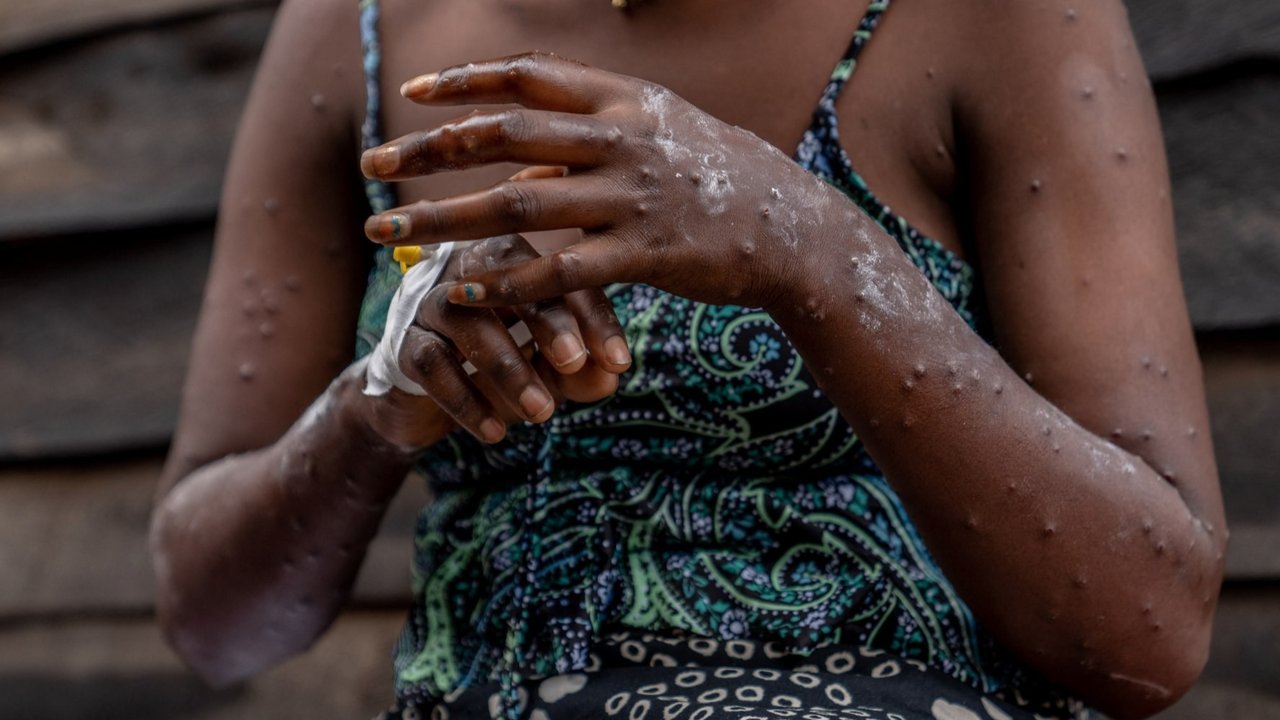 Wabah Mpox menginfeksi ratusan orang di Burundi. Para penderitanya mengharuskan menjalani perawatan di dalam bangsal pusat perawatan Mpox Rumah Sakit Universitas Kamenge di Bujumbura, ibu kota Burundi pada 22 Agustus 2024.