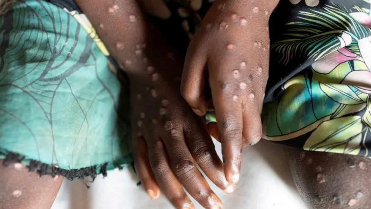 Wabah Mpox menginfeksi ratusan orang di Burundi. Para penderitanya mengharuskan menjalani perawatan di dalam bangsal pusat perawatan Mpox Rumah Sakit Universitas Kamenge di Bujumbura, ibu kota Burundi pada 22 Agustus 2024.