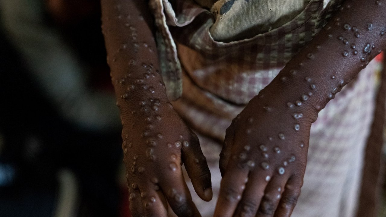 Wabah Mpox menginfeksi ratusan orang di Burundi. Para penderitanya mengharuskan menjalani perawatan di dalam bangsal pusat perawatan Mpox Rumah Sakit Universitas Kamenge di Bujumbura, ibu kota Burundi pada 22 Agustus 2024.