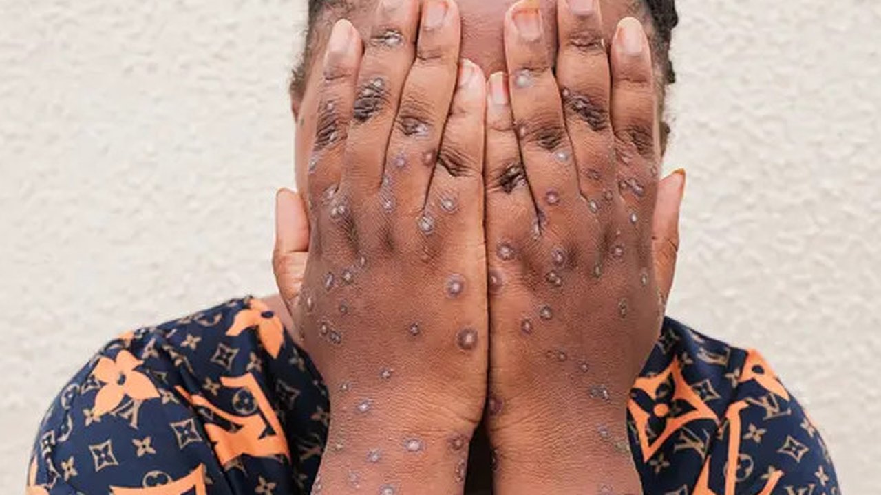 Tiga kasus mpox terdeteksi di Burundi pada akhir Juli, dan kementerian kesehatan melaporkan 153 kasus yang terkonfirmasi pada tanggal 18 Agustus. (Tchandrou NITANGA / AFP)