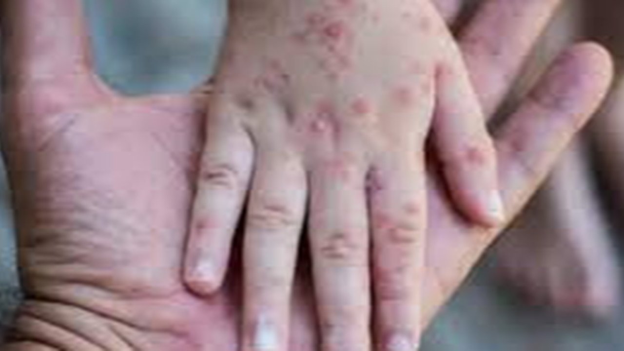 Ilustrasi penyakit cacar monyet (Istimewa)