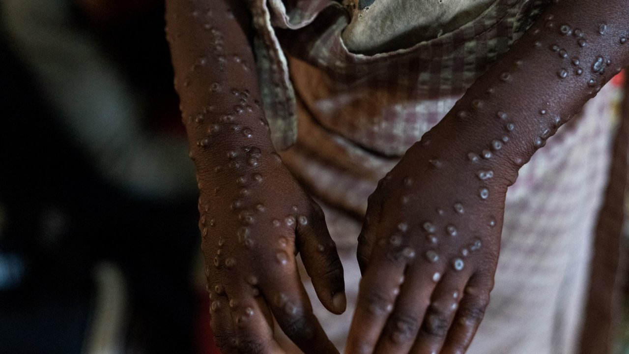 Tiga kasus mpox terdeteksi di Burundi pada akhir Juli, dan kementerian kesehatan melaporkan 153 kasus yang terkonfirmasi pada tanggal 18 Agustus. (Tchandrou NITANGA / AFP)
