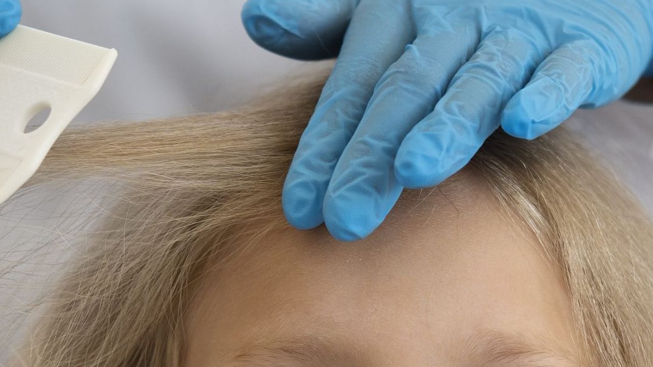 10 Cara Menghilangkan Kutu Rambut dan Telurnya Secara Alami dan Permanen
