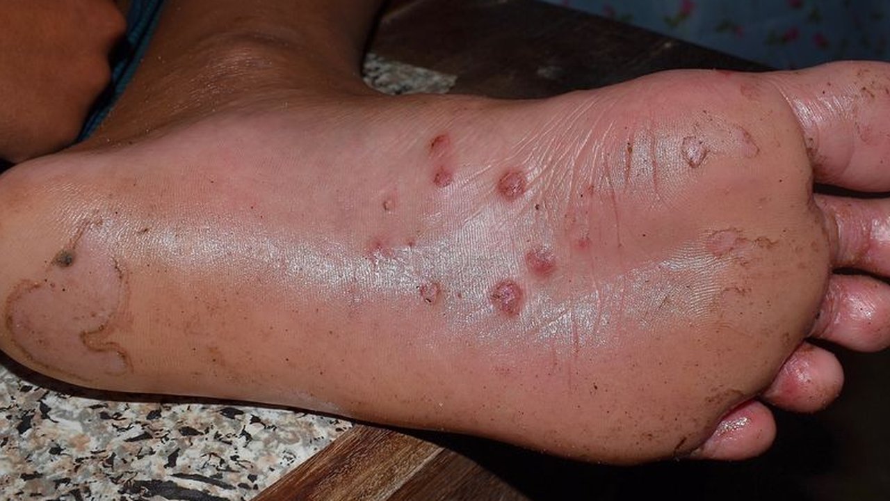 Kementerian Kesehatan mengungkap bahwa kasus Mpox menyebar dari DKI Jakarta hingga Kepulauan Riau.