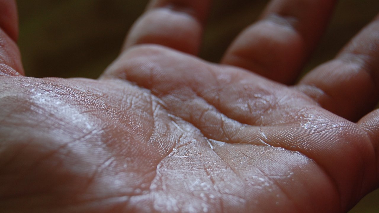 Penyebab Medis Tangan dan Kaki Berkeringat