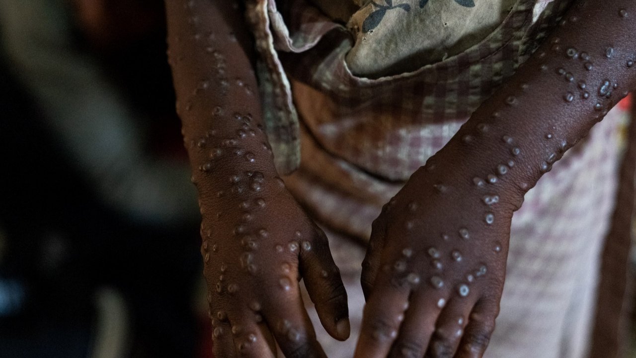 Wabah Mpox menginfeksi ratusan orang di Burundi. Para penderitanya mengharuskan menjalani perawatan di dalam bangsal pusat perawatan Mpox Rumah Sakit Universitas Kamenge di Bujumbura, ibu kota Burundi pada 22 Agustus 2024.
